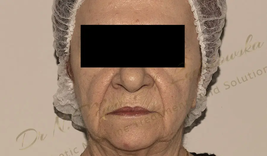 kobieta w podeszłym wieku lifting twarzy agnieszka ledniowska zabieg gabinet klinika profesjonalnie